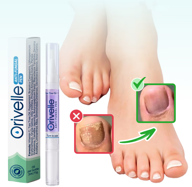 Una Forma Natural de Eliminar Los Hongos de Las Uñas - Para Siempre.