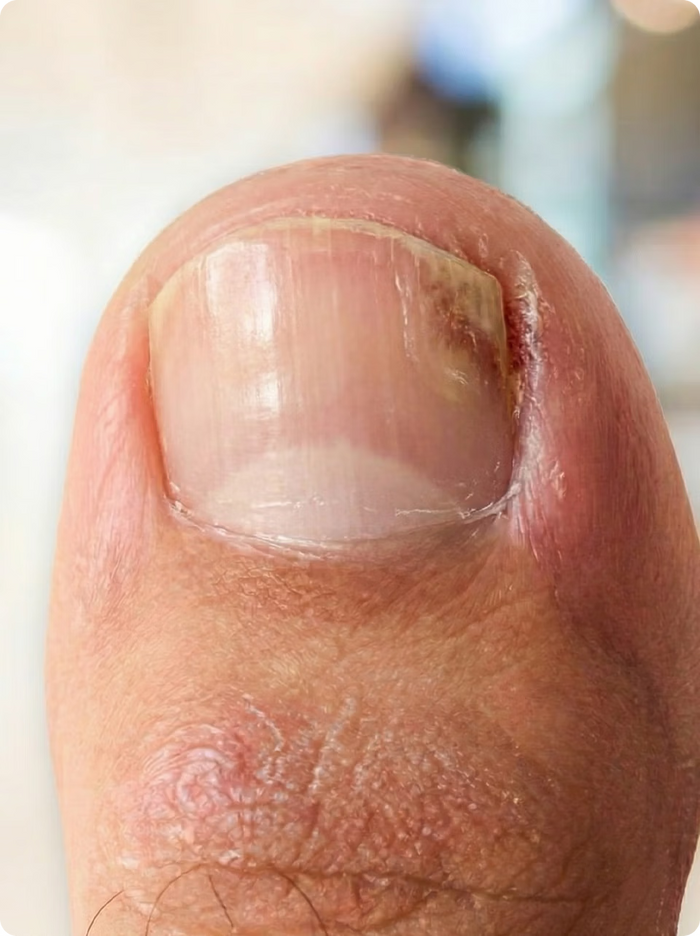 El hongo en las uñas de los pies se vuelve extremadamente grave si no se trata durante años.